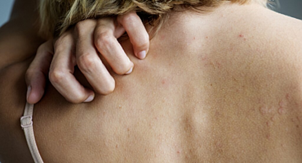 Sinsice İlerliyor: 52 Yaşındaki Kadının Yaşadığı Belirtiler Karaciğer Kanserini Ortaya Çıkardı