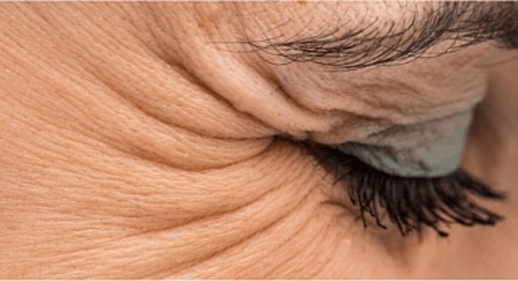 Genç ve Canlı Bir Görünüm İçin Doğal Yöntemler: Kaz Ayakları ve Kırışıklıklarla Başa Çıkmanın Sırları!